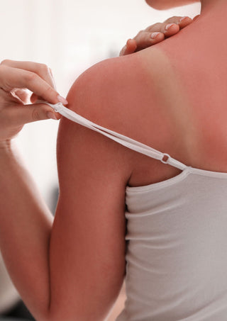 Verbrand! Wat nu? Zo herstel je jouw huid!