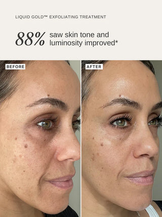 Alpha-H Liquid Gold Exfoliating Treatment limited resultaat