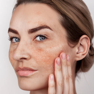 Wat is hyperpigmentatie?