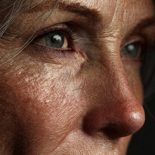 Zomer voorbij en nu pigmentvlekken! Wat kun je doen?