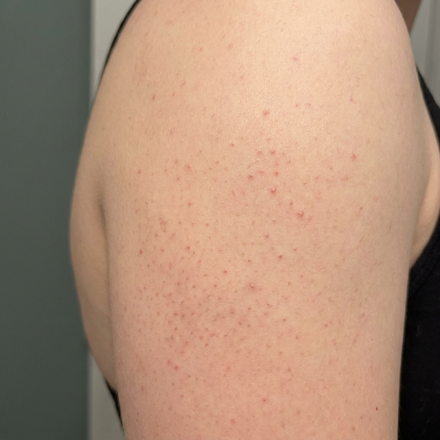 Keratosis pilaris kennisbank