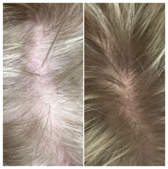 Calecim Advanced Hair System Kit 6 x ml result