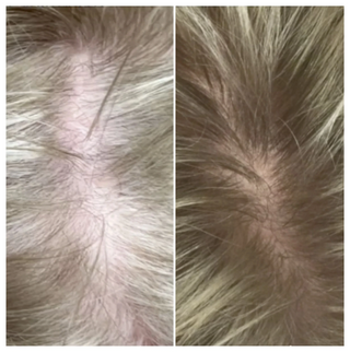 Calecim Advanced Hair System Kit 6 x ml result