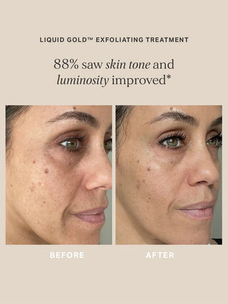 Liquid Gold Exfoliating Treatment 100ml