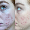 Alpha-H Clear Skin Tonic voor en na resultaat twee