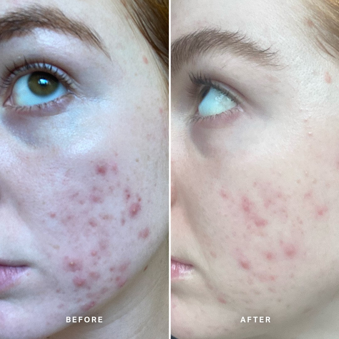 Alpha-H Clear Skin Tonic voor en na resultaat twee