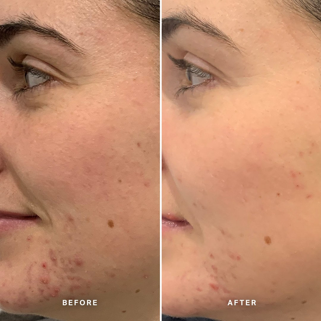 Alpha-H Clear Skin Tonic voor en na resultaat vier