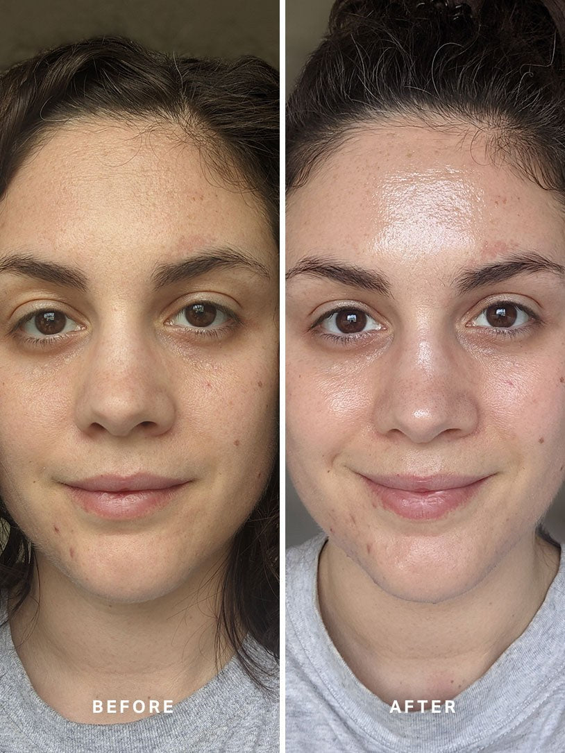 Alpha-H Liquid Gold Exfoliating Treatment voor en na resultaat twee
