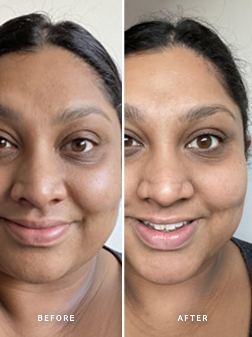 Alpha-H Liquid Gold Exfoliating Treatment voor en na resultaat vier